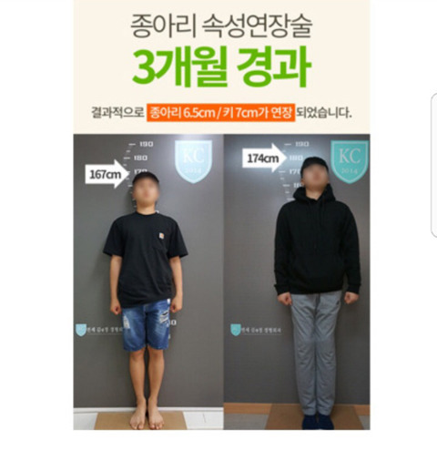 키 크는 수술 | 인스티즈